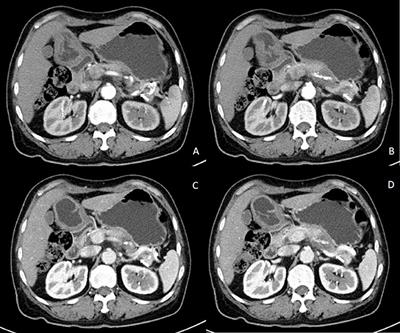 Dapagliflozin-Associated Euglycemic Diabetic Ketoacidosis in a Patient Who Underwent Surgery for Pancreatic Carcinoma: A Case Report